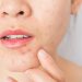 probiotici acne